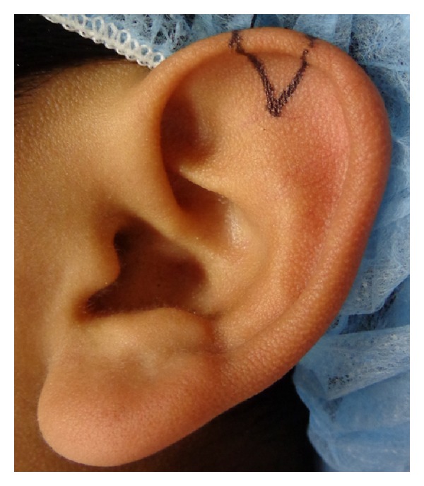 Evaluation of the use of auricular composite graft for secondary unilateral cleft lip nasal alar deformity repair.