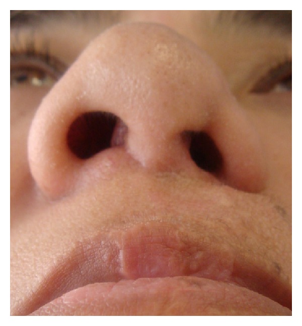 Evaluation of the use of auricular composite graft for secondary unilateral cleft lip nasal alar deformity repair.