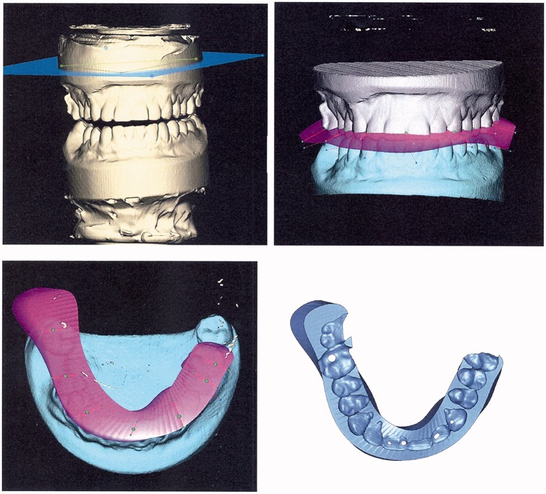 RapidSplint: virtual splint generation for orthognathic surgery - results of a pilot series.