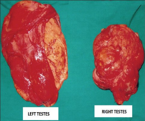 Bilateral paratesticular liposarcoma - a rare case report.
