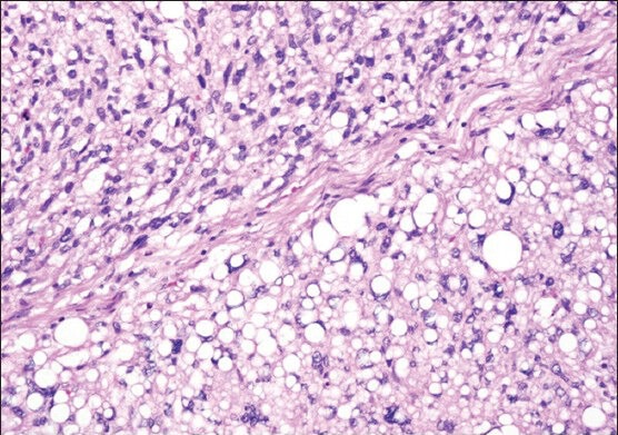 Bilateral paratesticular liposarcoma - a rare case report.