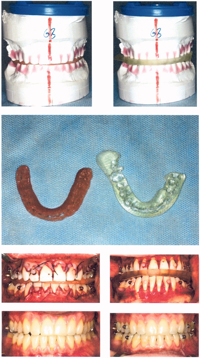 RapidSplint: virtual splint generation for orthognathic surgery - results of a pilot series.