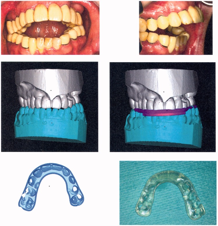 RapidSplint: virtual splint generation for orthognathic surgery - results of a pilot series.