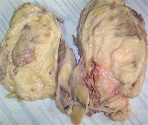 Bilateral paratesticular liposarcoma - a rare case report.