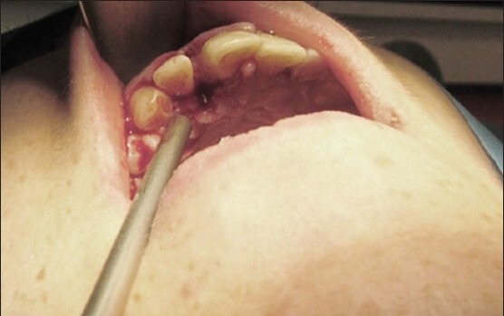 Esthetic Management of Gingival Lesions in Anterior Maxilla: The Role of VIP-CT Flap, a Technical Note.