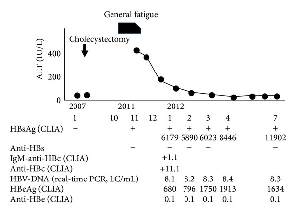 Clinical features of adult patients with acute hepatitis B virus infection progressing to chronic infection.