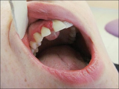 Esthetic Management of Gingival Lesions in Anterior Maxilla: The Role of VIP-CT Flap, a Technical Note.
