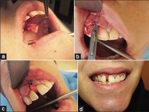 Esthetic Management of Gingival Lesions in Anterior Maxilla: The Role of VIP-CT Flap, a Technical Note.