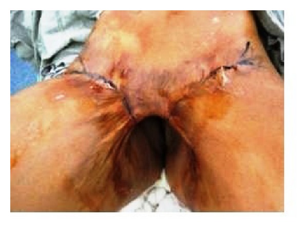 Outcome of split thickness skin grafting and multiple z-plasties in postburn contractures of groin and perineum: a 15-year experience.