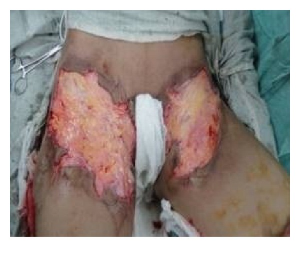 Outcome of split thickness skin grafting and multiple z-plasties in postburn contractures of groin and perineum: a 15-year experience.