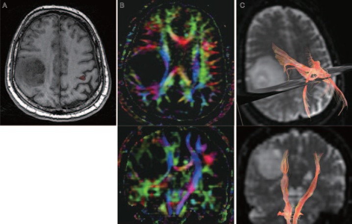 Novel strategies in glioblastoma surgery aim at safe, supra-maximum resection in conjunction with local therapies.