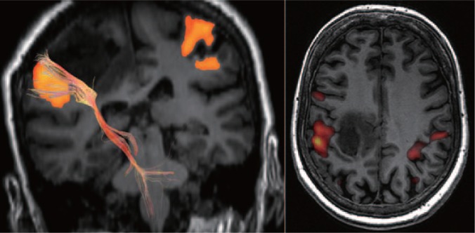 Novel strategies in glioblastoma surgery aim at safe, supra-maximum resection in conjunction with local therapies.