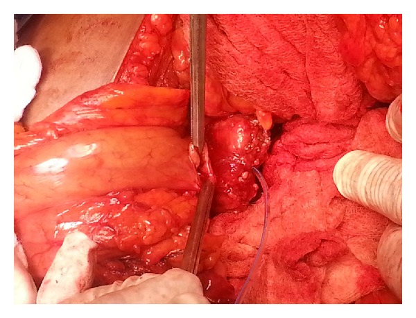 Evaluation of a new modification of pancreaticogastrostomy after pancreaticoduodenectomy: anastomosis of the pancreatic duct to the gastric mucosa with invagination of the pancreatic remnant end into the posterior gastric wall for patients with cancer head of pancreas and periampullary carcinoma in terms of postoperative pancreatic fistula formation.