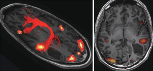 Novel strategies in glioblastoma surgery aim at safe, supra-maximum resection in conjunction with local therapies.