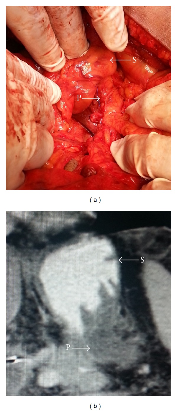 Evaluation of a new modification of pancreaticogastrostomy after pancreaticoduodenectomy: anastomosis of the pancreatic duct to the gastric mucosa with invagination of the pancreatic remnant end into the posterior gastric wall for patients with cancer head of pancreas and periampullary carcinoma in terms of postoperative pancreatic fistula formation.