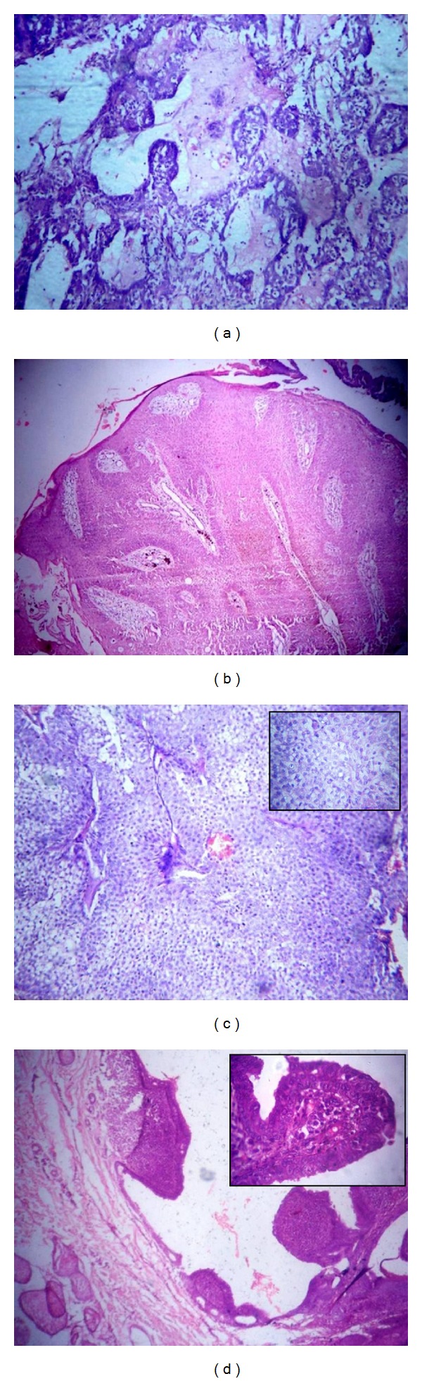 Histopathological study of skin adnexal tumours-institutional study in South India.