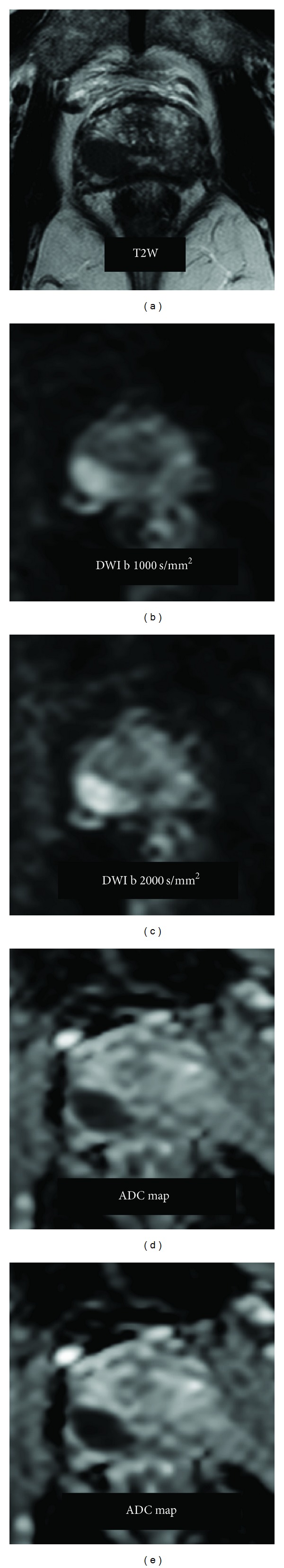 DWI of Prostate Cancer: Optimal b-Value in Clinical Practice.