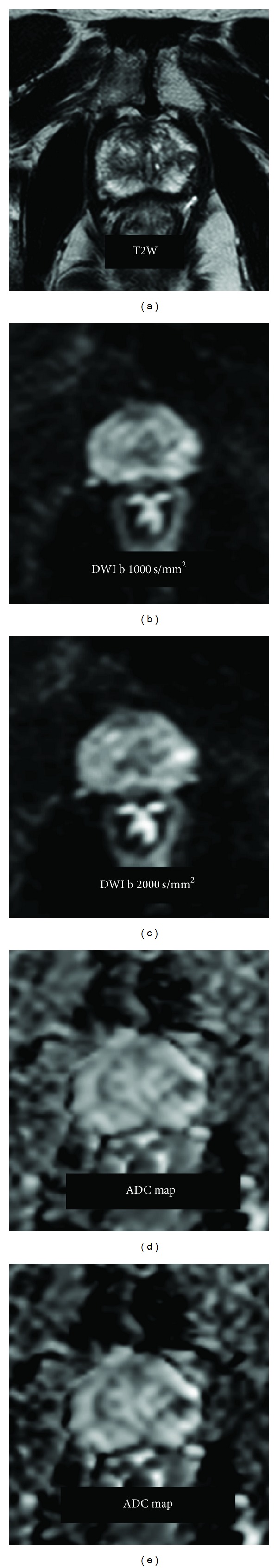 DWI of Prostate Cancer: Optimal b-Value in Clinical Practice.