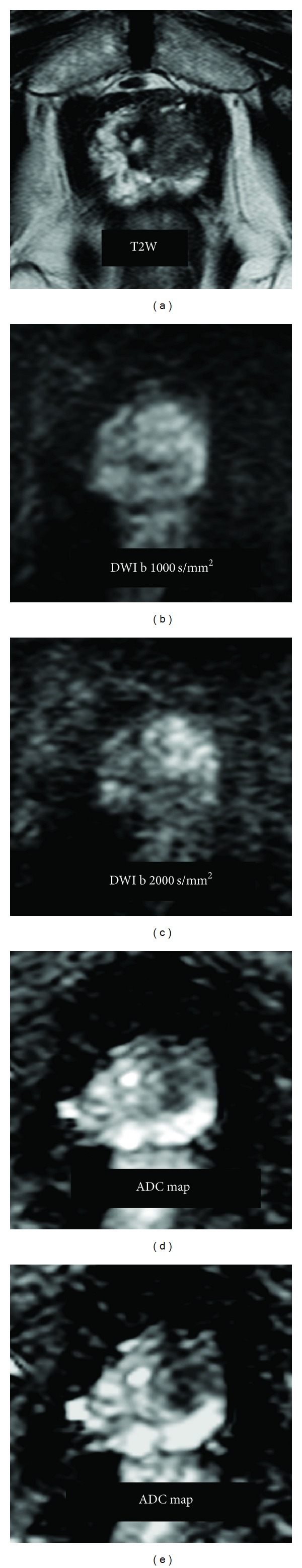 DWI of Prostate Cancer: Optimal b-Value in Clinical Practice.