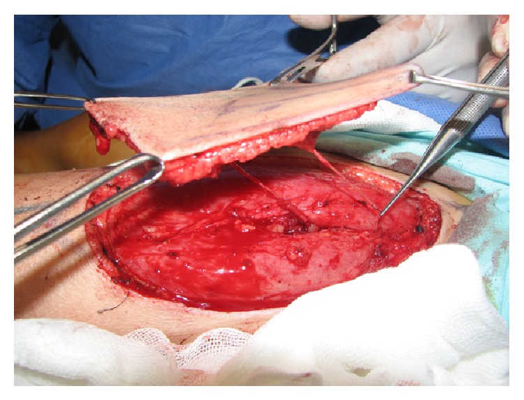 Aesthetic and functional outcomes of the innervated and thinned anterolateral thigh flap in reconstruction of upper limb defects.