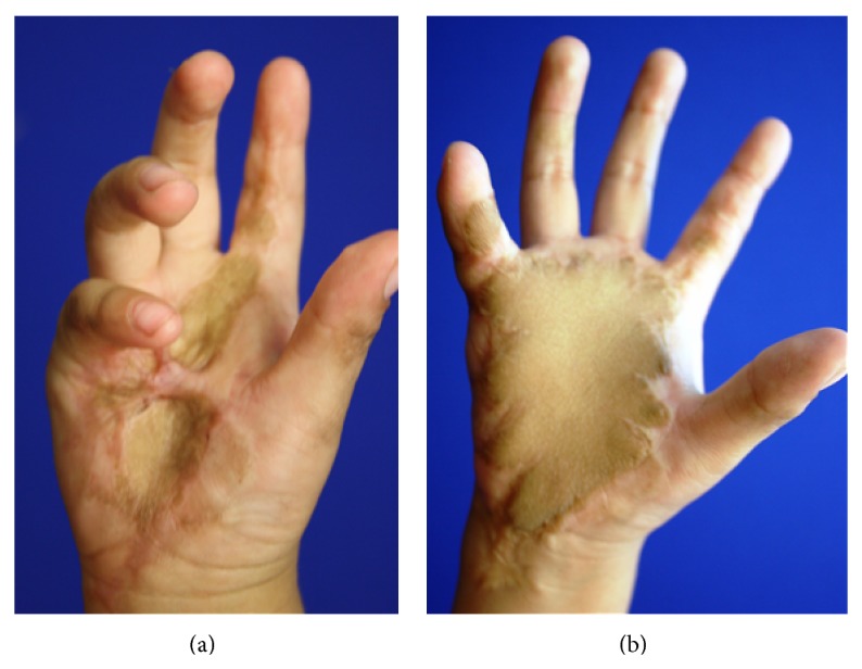 Aesthetic and functional outcomes of the innervated and thinned anterolateral thigh flap in reconstruction of upper limb defects.