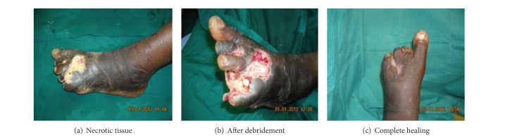 Strategy of surgical management of peripheral neuropathy form of diabetic foot syndrome in ghana.