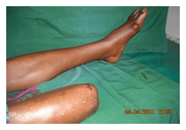 Strategy of surgical management of peripheral neuropathy form of diabetic foot syndrome in ghana.