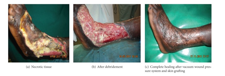 Strategy of surgical management of peripheral neuropathy form of diabetic foot syndrome in ghana.