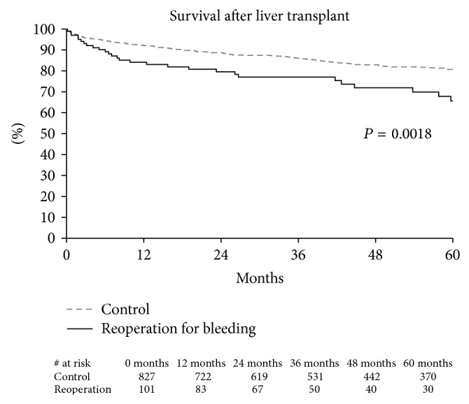 Risk Factors Associated with Reoperation for Bleeding following Liver Transplantation.