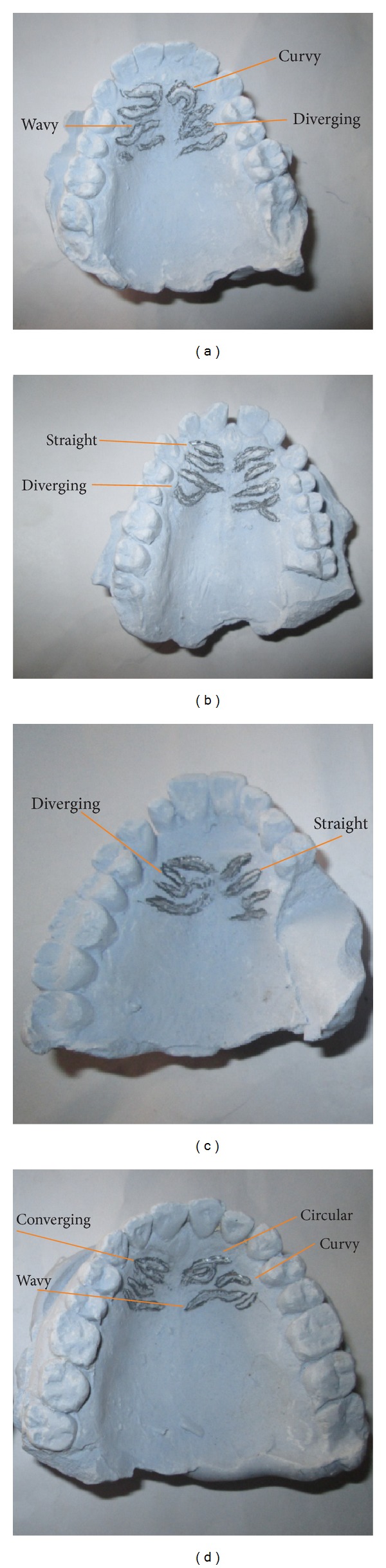 A Comparative Study of Palatal Rugae Patterns among Igbo and Ikwerre Ethnic Groups of Nigeria: A University of Port Harcourt Study.