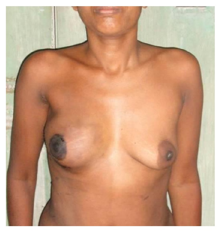 Skin sparing mastectomy with preservation of nipple areola complex and immediate breast reconstruction in patients with breast cancer: a single centre prospective study.
