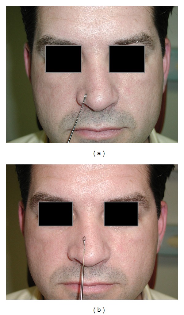 The effectiveness of modified cottle maneuver in predicting outcomes in functional rhinoplasty.
