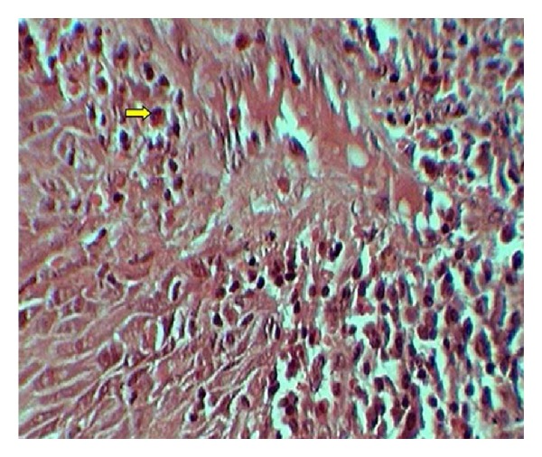 Assessment of tissue eosinophilia as a prognosticator in oral epithelial dysplasia and oral squamous cell carcinoma-an image analysis study.