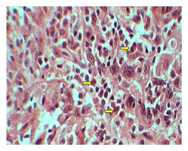 Assessment of tissue eosinophilia as a prognosticator in oral epithelial dysplasia and oral squamous cell carcinoma-an image analysis study.