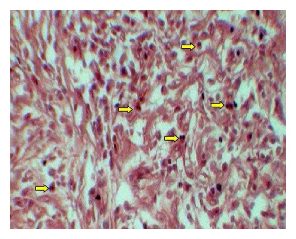 Assessment of tissue eosinophilia as a prognosticator in oral epithelial dysplasia and oral squamous cell carcinoma-an image analysis study.