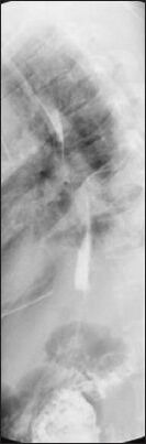 A case of esophagopericardial fistula as a complication of upper gastro-intestinal endoscopy.