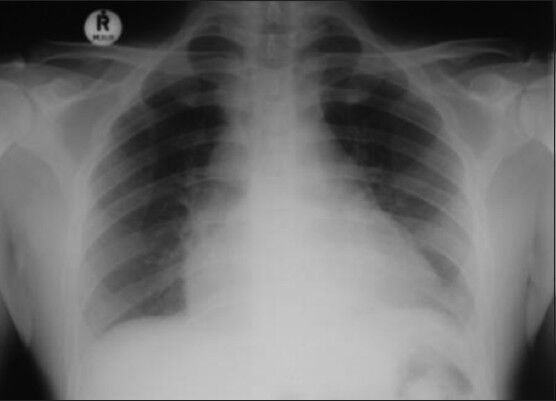 A case of esophagopericardial fistula as a complication of upper gastro-intestinal endoscopy.