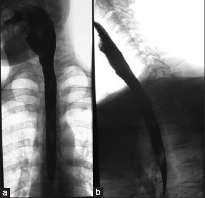 A case of esophagopericardial fistula as a complication of upper gastro-intestinal endoscopy.
