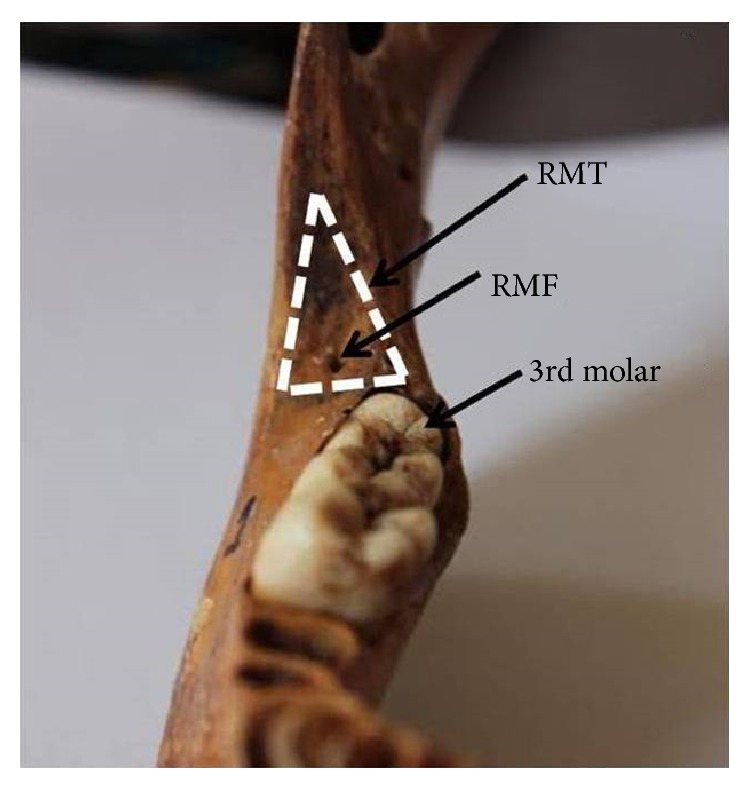 Occurrence of the retromolar foramen in dry mandibles of South-eastern part of India: a morphological study with review of the literature.