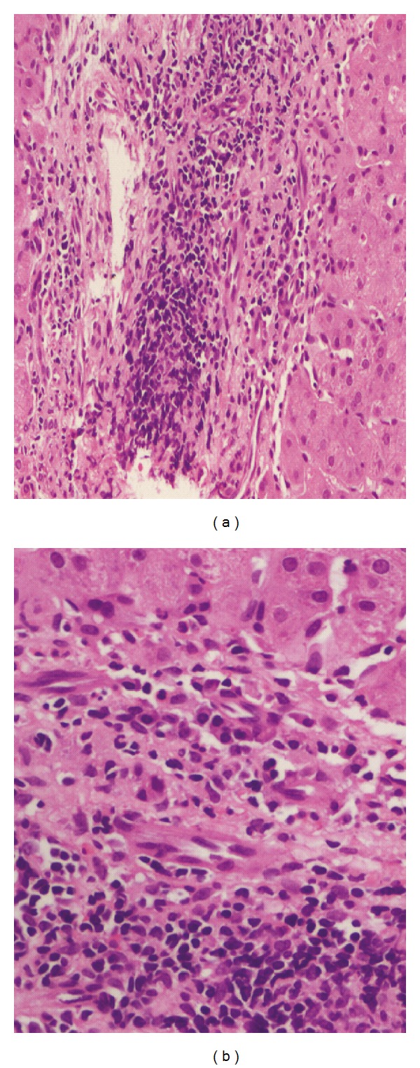 Spectrum of Histomorphologic Findings in Liver in Patients with SLE: A Review.