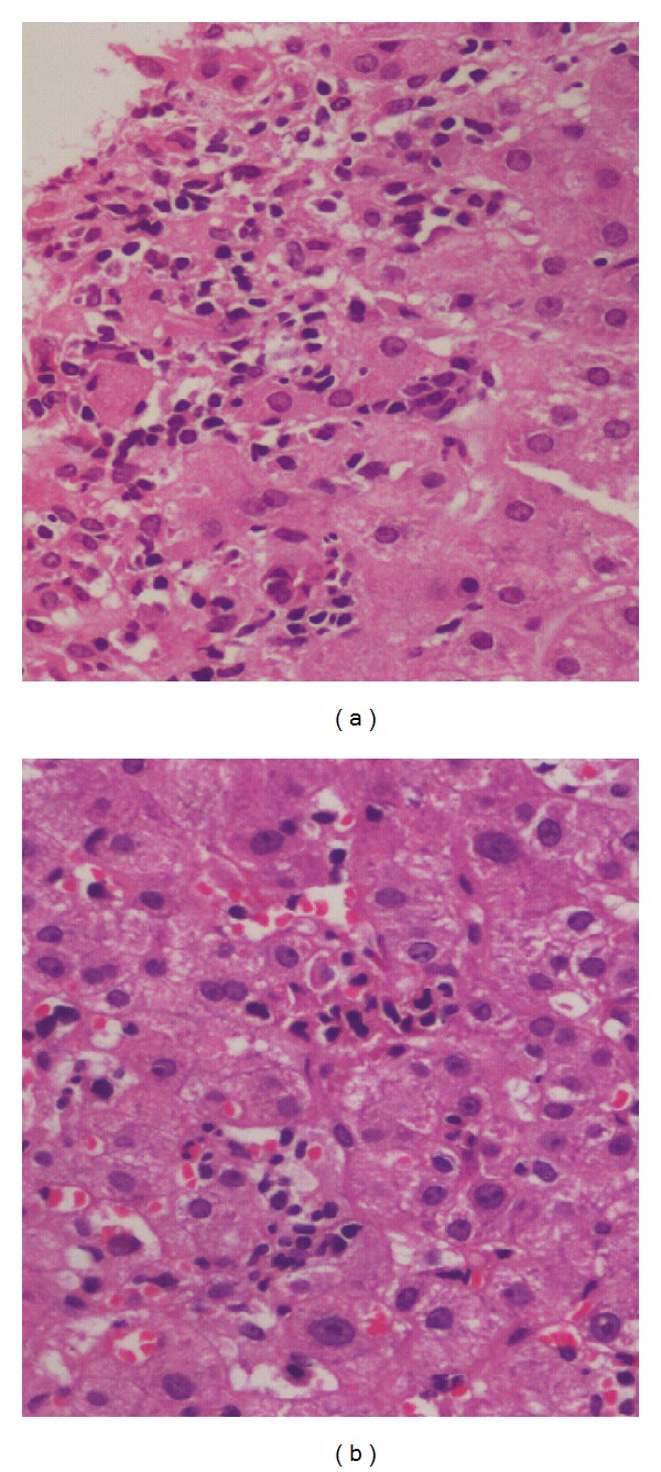 Spectrum of Histomorphologic Findings in Liver in Patients with SLE: A Review.