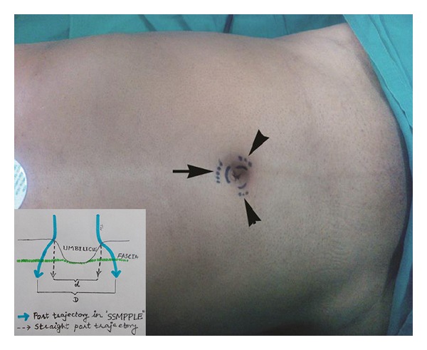 Prospective Observational Study of Single-Site Multiport Per-umbilical Laparoscopic Endosurgery versus Conventional Multiport Laparoscopic Cholecystectomy: Critical Appraisal of a Unique Umbilical Approach.