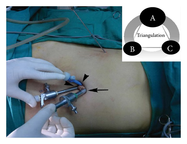 Prospective Observational Study of Single-Site Multiport Per-umbilical Laparoscopic Endosurgery versus Conventional Multiport Laparoscopic Cholecystectomy: Critical Appraisal of a Unique Umbilical Approach.