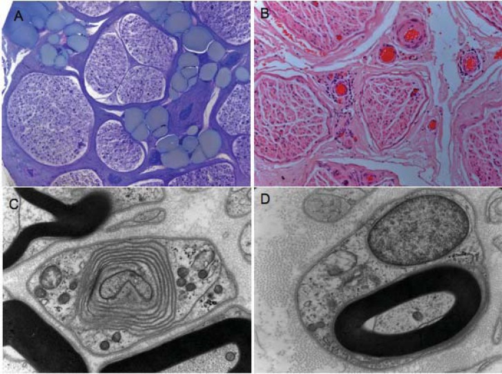 HCV-related central and peripheral nervous system demyelinating disorders.