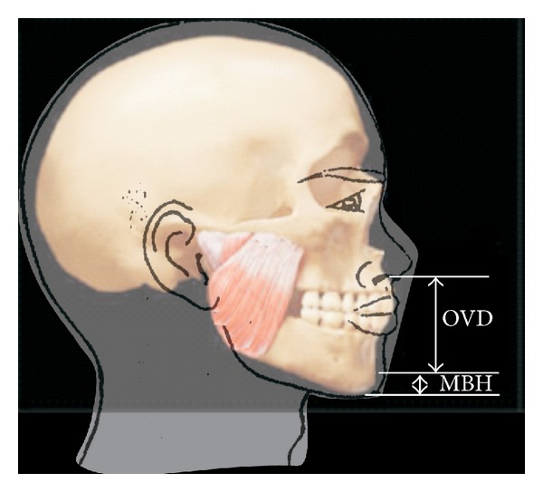 Analysis of occlusal vertical dimension and mandibular Basal bone height in a nigerian population.