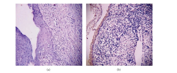 Calretinin as a diagnostic adjunct for ameloblastoma.
