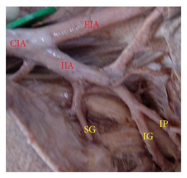 Variability in the branching pattern of the internal iliac artery in Indian population and its clinical importance.