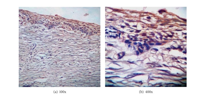 Calretinin as a diagnostic adjunct for ameloblastoma.