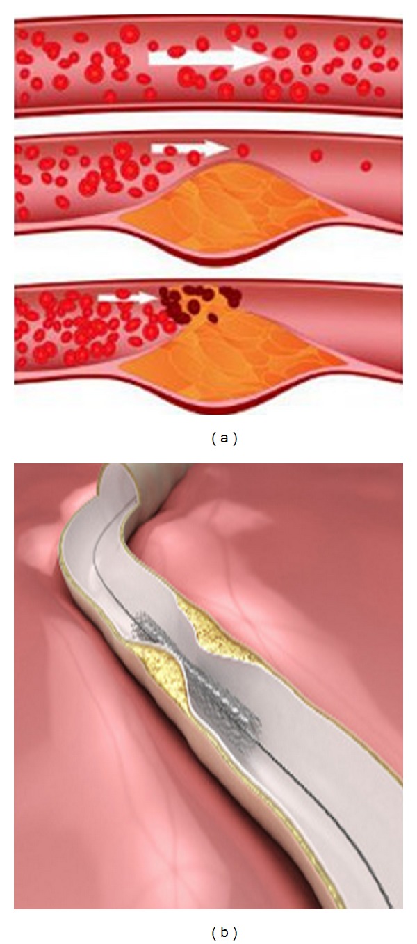 Analysis of Flow Characteristics of the Blood Flowing through an Inclined Tapered Porous Artery with Mild Stenosis under the Influence of an Inclined Magnetic Field.