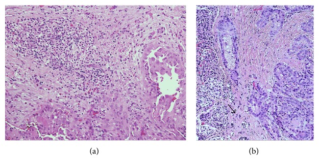 Parathyroid gland involvement by thyroid cancer: results from a large series of thyroidectomies performed in two italian university hospitals and review of the literature.